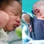 Bebê nasce com ombros virados para baixo e cotovelos virados para cima; entenda a condição