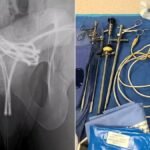 Entenda a prática sexual que deixou homem de 21 anos hospitalizado com cabo USB na uretra