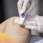 Maceió amplia acesso ao Implanon e já realiza quase 6 mil implantes contraceptivos